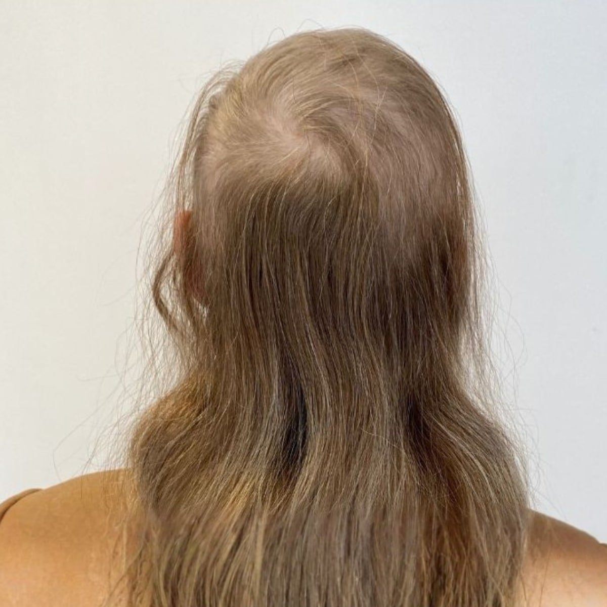 Rep-Hair gegen Haarausfall Frau