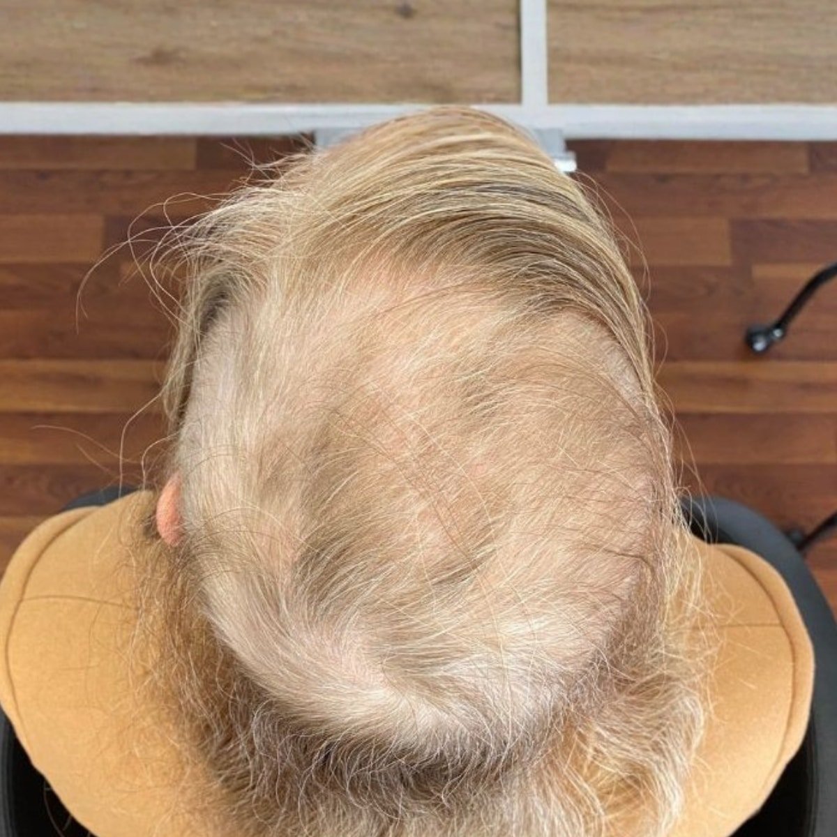Rep Hair Haarwachstum nach 4 Wochen Ergebnis