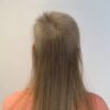 Rep-Hair gegen Haarausfall Frau Wirkung Ergebnis